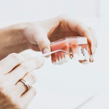 Ako vam nedostaje nekoliko zubi, ne očajavajte. Zubni implantati su široko dostupni, lako se ugrađuju, čak im je i cijena razumna. Saznajte detalje!