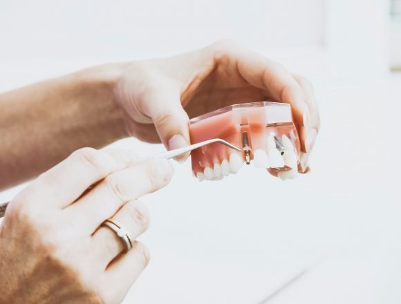 Ako vam nedostaje nekoliko zubi, ne očajavajte. Zubni implantati su široko dostupni, lako se ugrađuju, čak im je i cijena razumna. Saznajte detalje! Ako vam nedostaje nekoliko zubi, ne očajavajte. Zubni implantati su široko dostupni, lako se ugrađuju, čak im je i cijena razumna. Saznajte detalje!