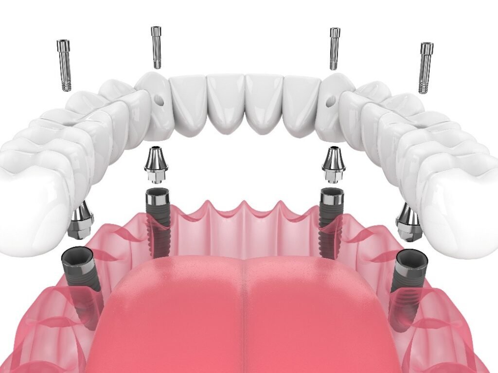 All-on-4 u Dentico centru: Najbrži put do novog osmijeha, fotografija